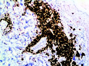 IHC of S-100 on an FFPE Malignant Melanoma Tissue