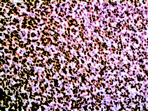IHC of TLE1 on an FFPE Synovial Sarcoma Tissue