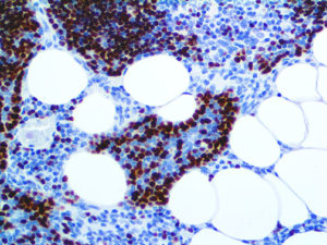 IHC of TdT on anFFPE Acute Lymphoblastic Lymphoma Tissue
