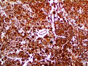 IHC of Vimentin on an FFPE Melanoma Tissue